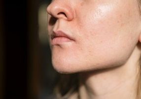 woman dry skin
