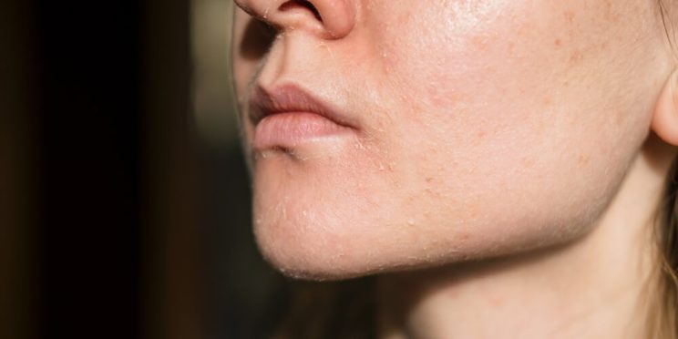 woman dry skin