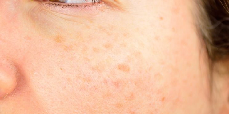 woman skin spots